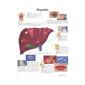 Hepatitis   Anatomical Chart  Industrial & Scientific
