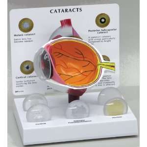 Cataract Eye Model  Industrial & Scientific